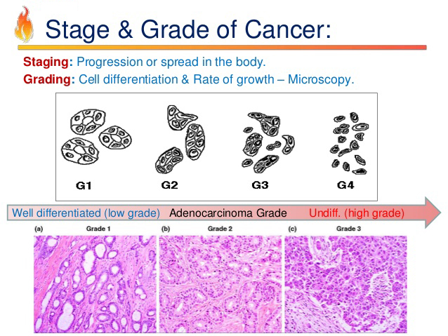 cancer-staging-and-grading-chart